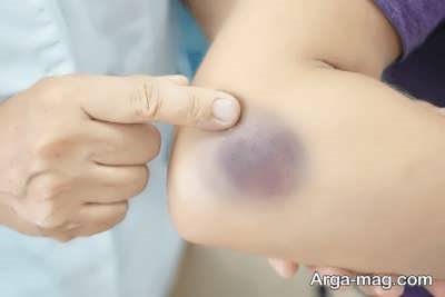 کبودی بی دلیل بدن نشانه چیست؟ بررسی علل و راه های درمان