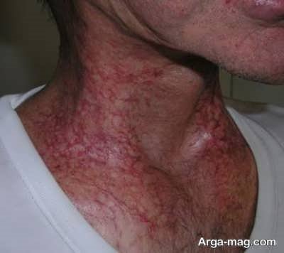 مسمومیت پرتوی چیست و چگونه اتفاق می‌افتد؟