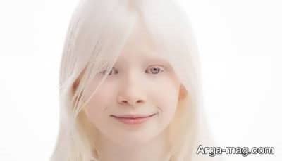 هر آنچه باید درباره بیماری آلبینیسم (زالی) بدانید