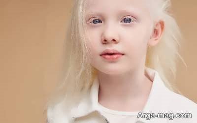 انواع آلبینیسم