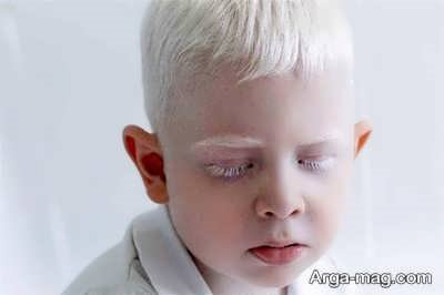 آلبینیسم هرمانسکی پودلاک