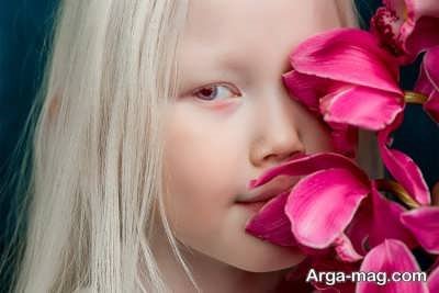 بیماری آلبینیسم