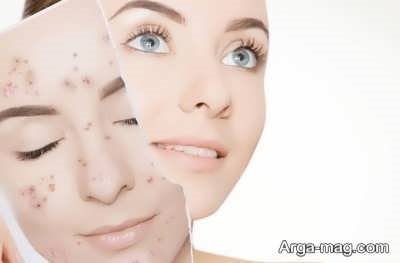 از بین بردن جوش ها با هیالورونیک اسید