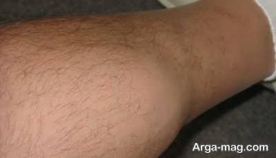 تیروئید و ریزش مو در بدن 