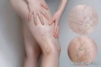 نشانه های گرفتگی عروق در بدن 