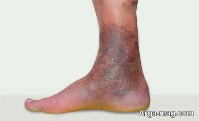 گرفتگی عروق پا