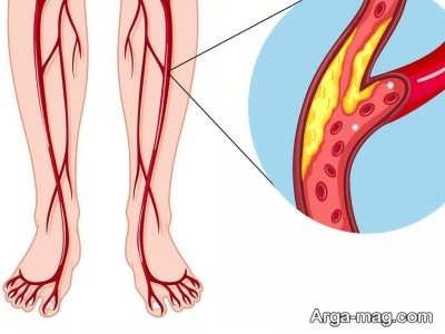 درمان های سنتی برای گرفتگی عروق