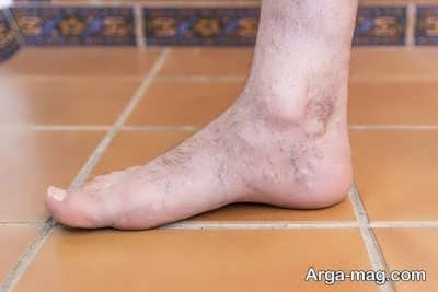 درمان گرفتگی عروق با استفاده از بای پس