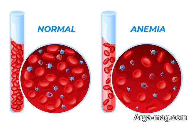 اقسام کم خونی