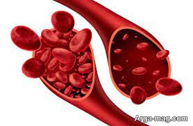 انواع کم خونی