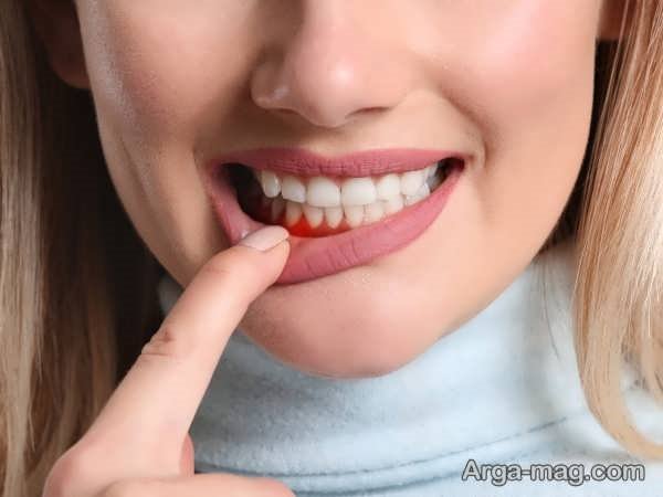 انواع بیماری لثه و مشکلات مربوط به آن