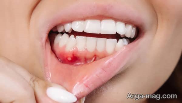 انواع بیماری لثه و مشکلات آن