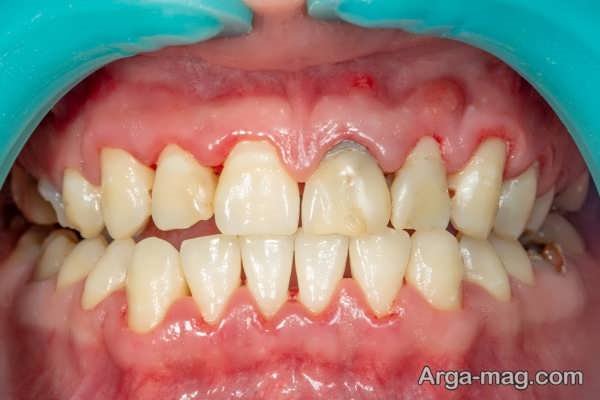 التهابات و عفونت های لثه