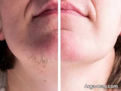 کاهش رشد موی صورت بدون آسیب به پوست؛ راهنمای کاربردی