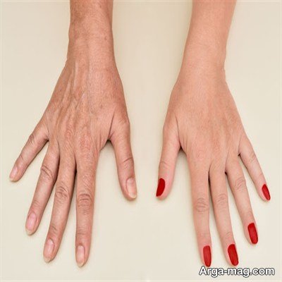 آشنایی با روش های درمان چروک دست