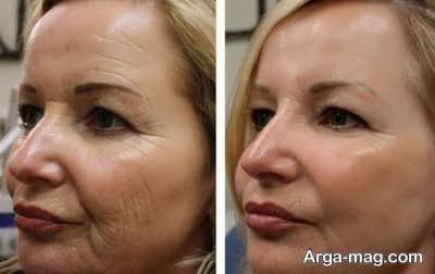 مزیت های هایفو 