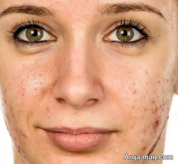 راه های خلاص شدن از جوش صورت در میانسالی بدون داروهای سنگین