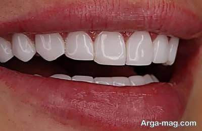 مزایای کامپوزیت لبه شیشه ای برای داشتن دندان های طبیعی