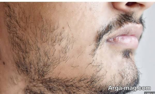 کندی ریش درآوردن