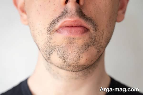 تاخیر در ریش درآوردن