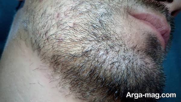 تاخیر در ریش درآوردن