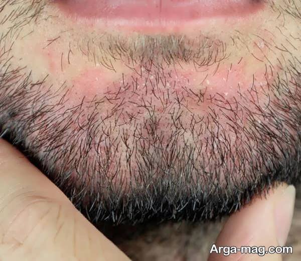 تاخیر در ریش درآوردن