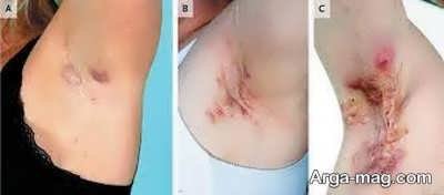 بیماری پوستی هیدرآدنیت چیست؟ علائم، دلایل و درمان