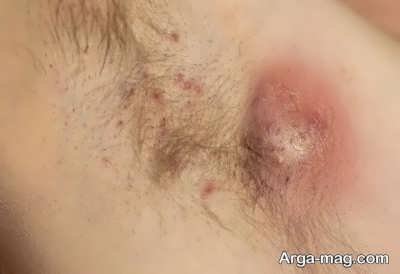 مرض پوستی هیدرآدنیت