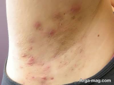 مریضی پوستی هیدرآدنیت