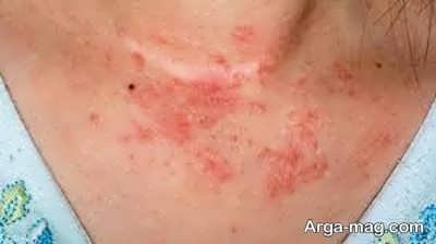 بیماری پوستی هیدرآدنیت