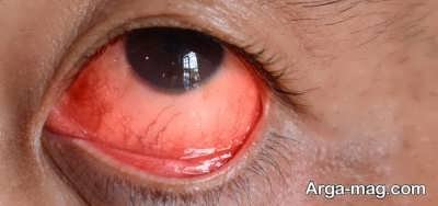 عوارض لنز دائمی چشم که کسی به شما نمی گوید!