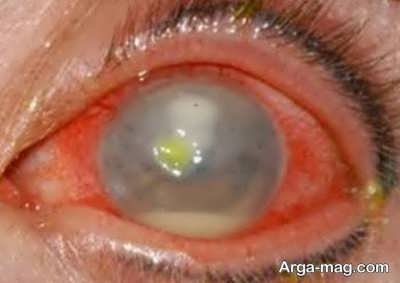 عارضه های لنز دائمی چشم