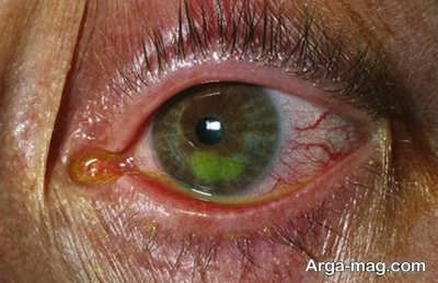 پیامد های لنز دائمی چشم