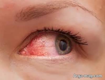 عوارض لنز دائمی چشم