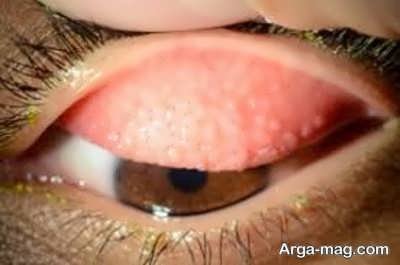 عوارض لنز دائمی چشم