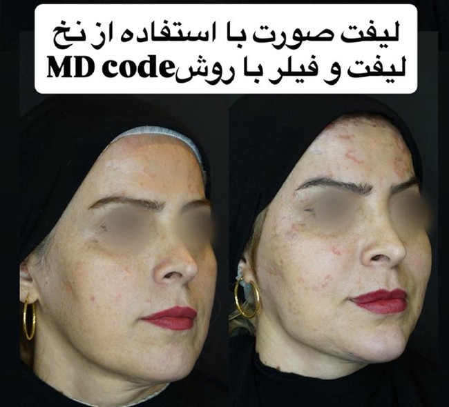 تزریق ژل و فیلر در رشت