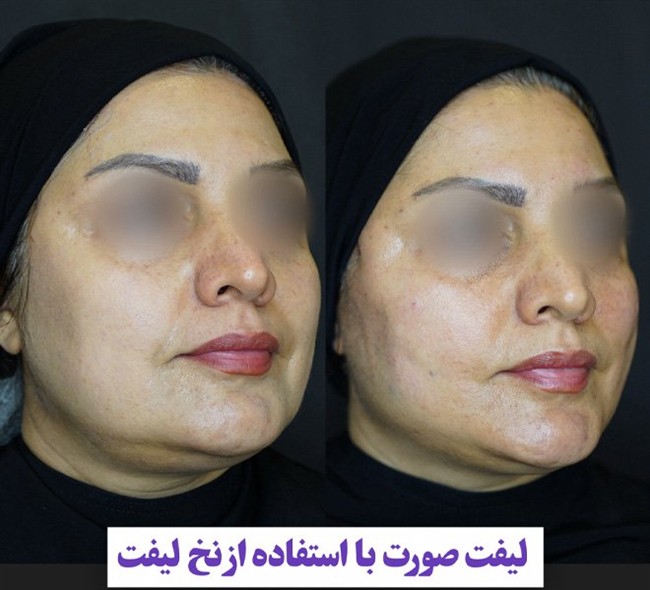 قیمت لیفت با نخ در رشت