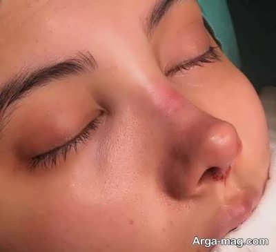 تعبیر خواب عمل بینی؛ رازهای جالب پشت این خواب