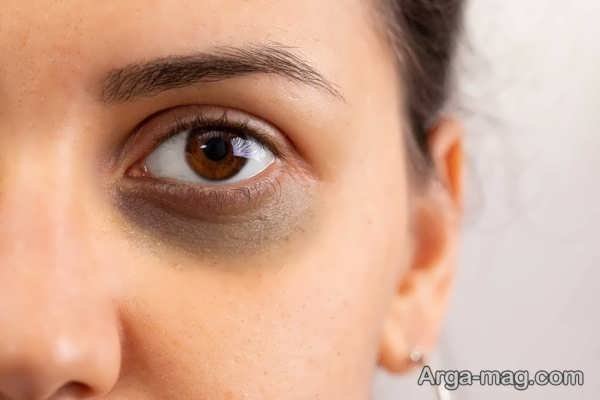 بهترین راه های از بین بردن تیرگی دور چشم