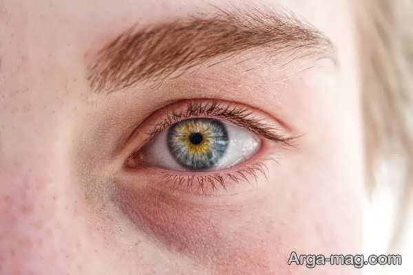 از بین بردن لکه های دور چشم