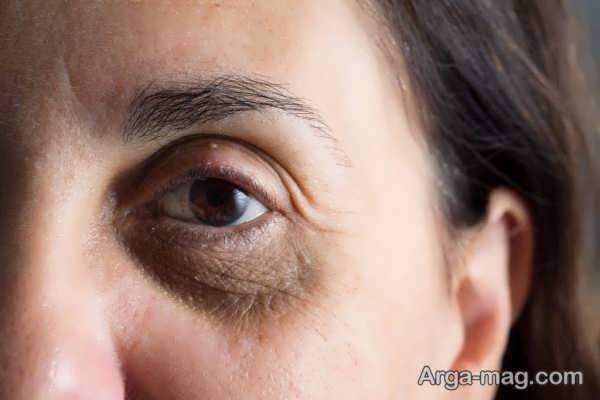 روش های درمان لکه های اطراف چشم