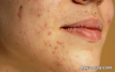 نحوه ایجاد جوش صورت