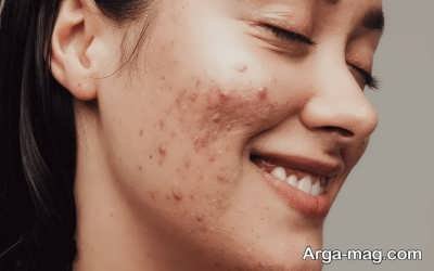 چگونگی بروز انواعی از جوش ها 