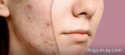 طرز تشکیل جوش کیستی صورت