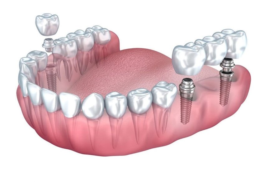 پل دندان بهتر است یا ایمپلنت؟ مقایسه کامل + راهنمای انتخاب