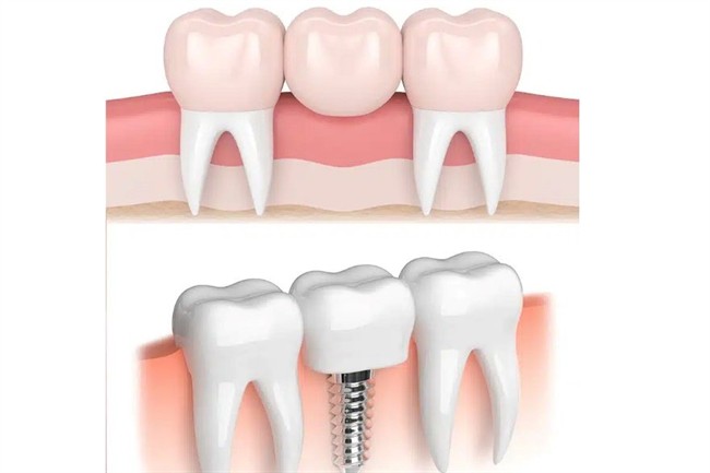 بریج یا ایمپلنت؛ کدام برای شما مناسبتر است؟