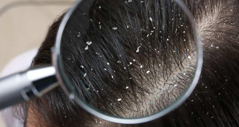 درمان شوره و پوسته شدن سر بعد از کاشت مو؛ روش‌های خانگی و دارویی