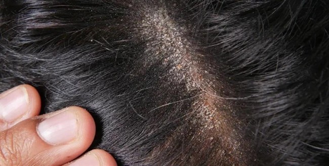 دلمه‌های زخم بعد از کاشت مو