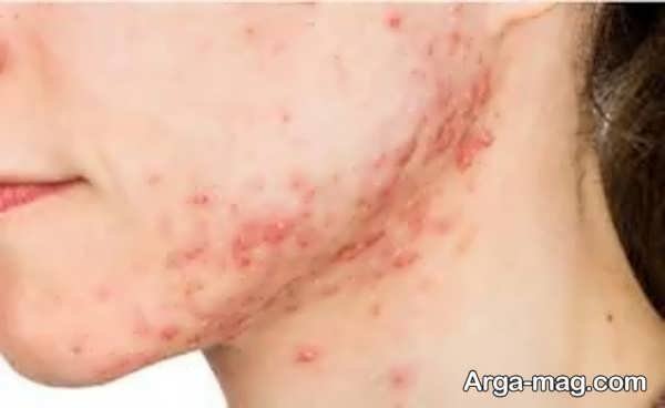 عوارض کرم موبر صورت