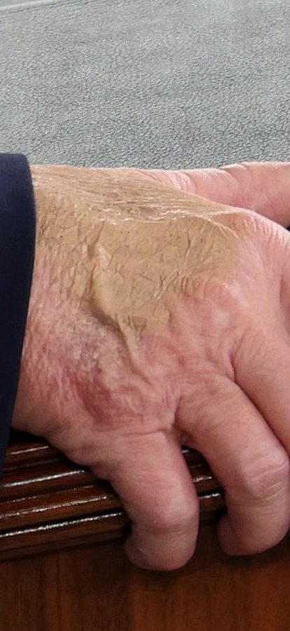 عکس: عارضه پوستی ترامپ چیست؟